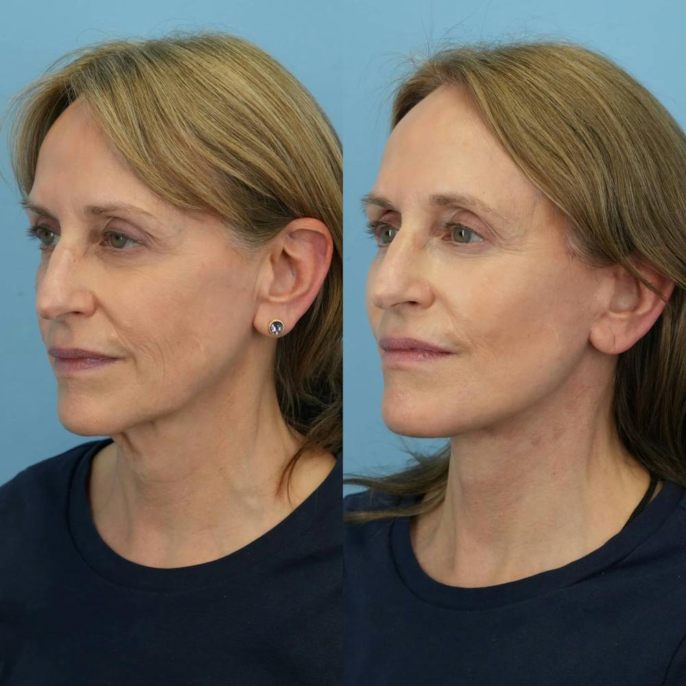 Facelift Before & After Gallery - Patient 310119 - Image 5