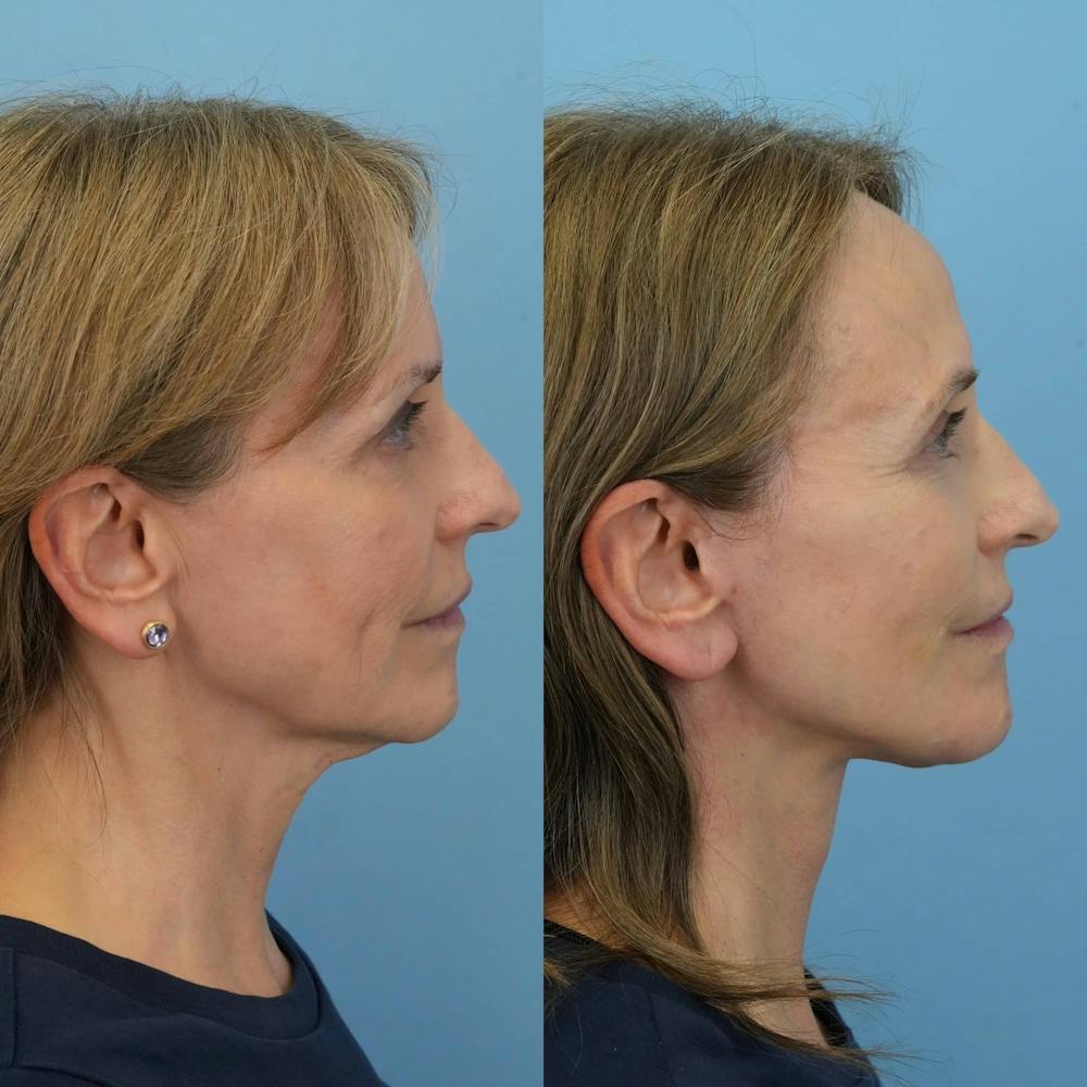 Facelift Before & After Gallery - Patient 310119 - Image 3
