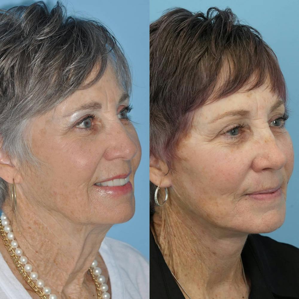 Facelift Before & After Gallery - Patient 397874 - Image 1