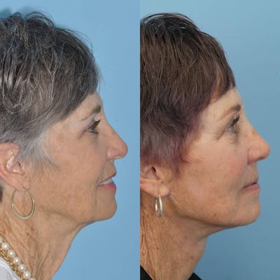 Facelift Before & After Gallery - Patient 397874 - Image 2