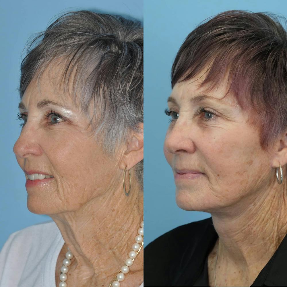 Facelift Before & After Gallery - Patient 397874 - Image 3