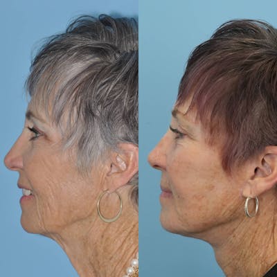 Facelift Before & After Gallery - Patient 397874 - Image 4