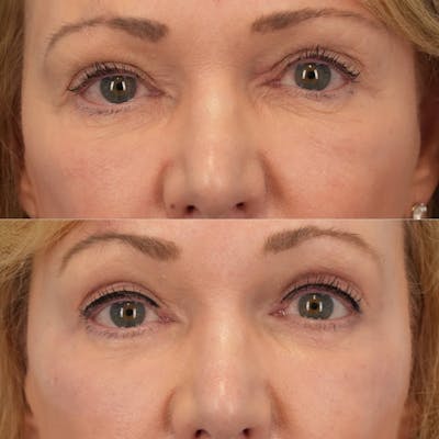 Laser Resurfacing Before & After Gallery - Patient 278857 - Image 1