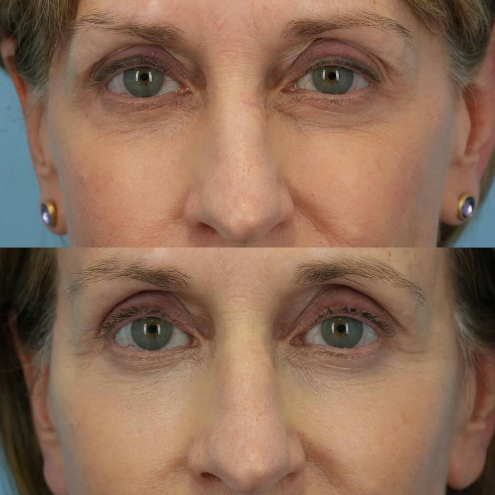 Lower Eyelids Before & After Gallery - Patient 869755 - Image 1