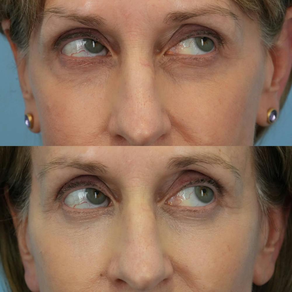 Lower Eyelids Before & After Gallery - Patient 869755 - Image 3