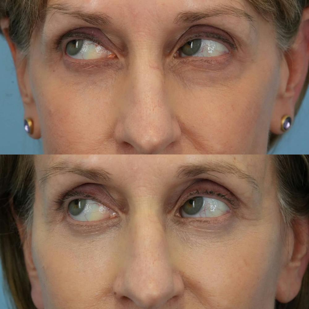 Lower Eyelids Before & After Gallery - Patient 869755 - Image 4