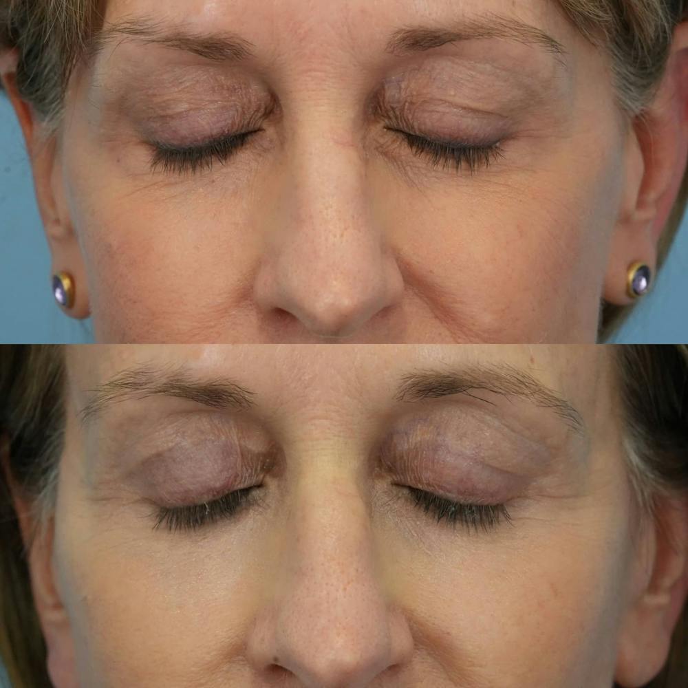 Lower Eyelids Before & After Gallery - Patient 869755 - Image 5