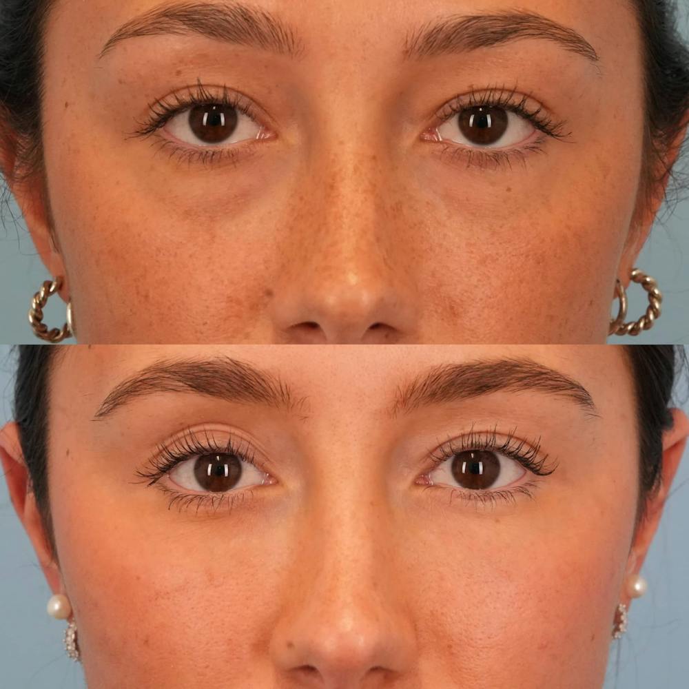 Lower Eyelids Before & After Gallery - Patient 332662 - Image 1