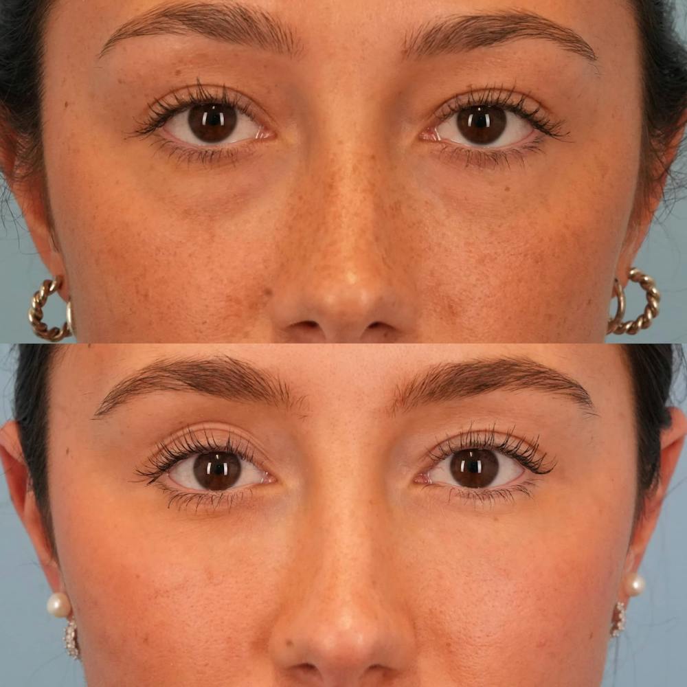 Lower Eyelids Before & After Gallery - Patient 332662 - Image 1