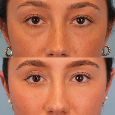 Lower Eyelids Before & After Gallery - Patient 332662 - Image 1