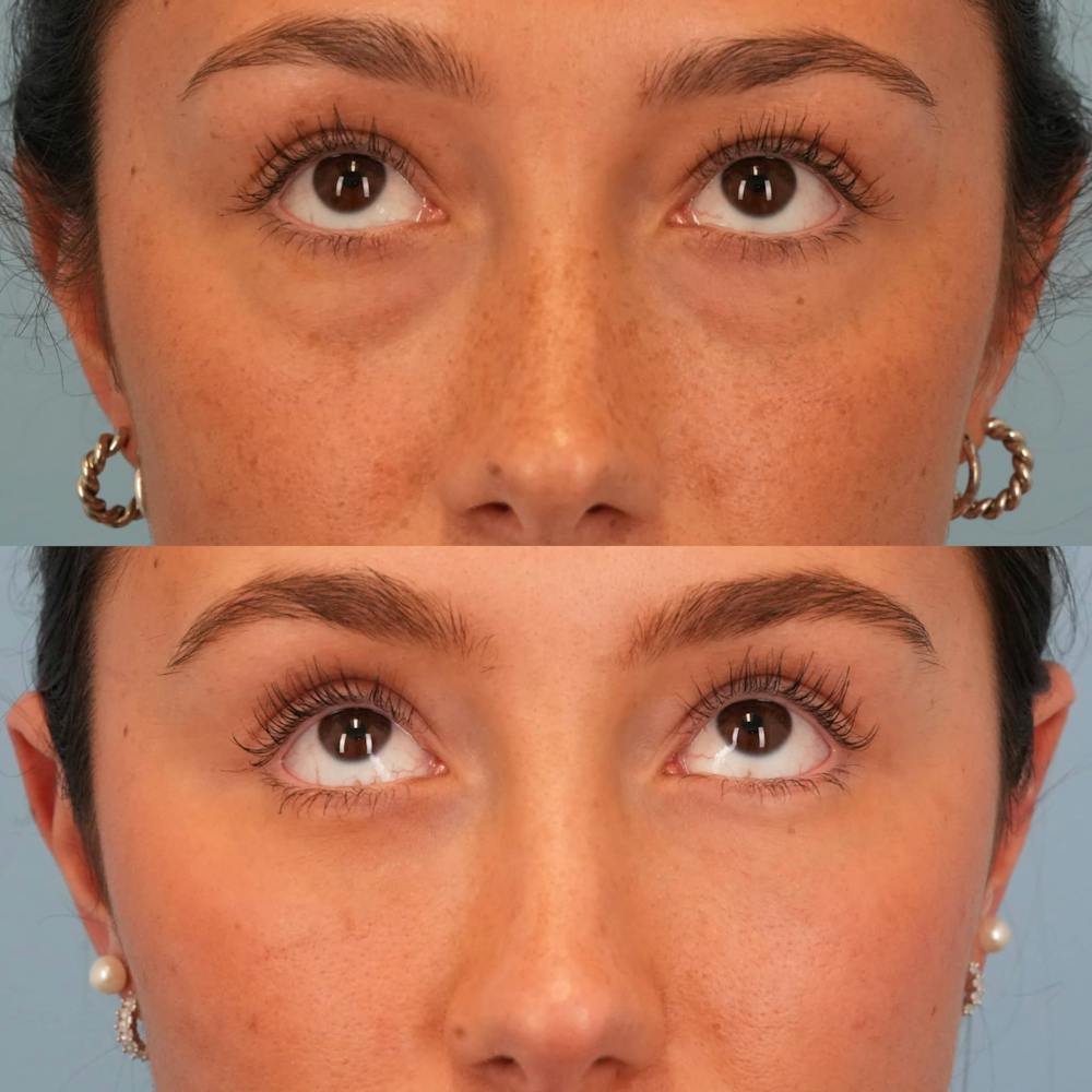 Lower Eyelids Before & After Gallery - Patient 332662 - Image 2
