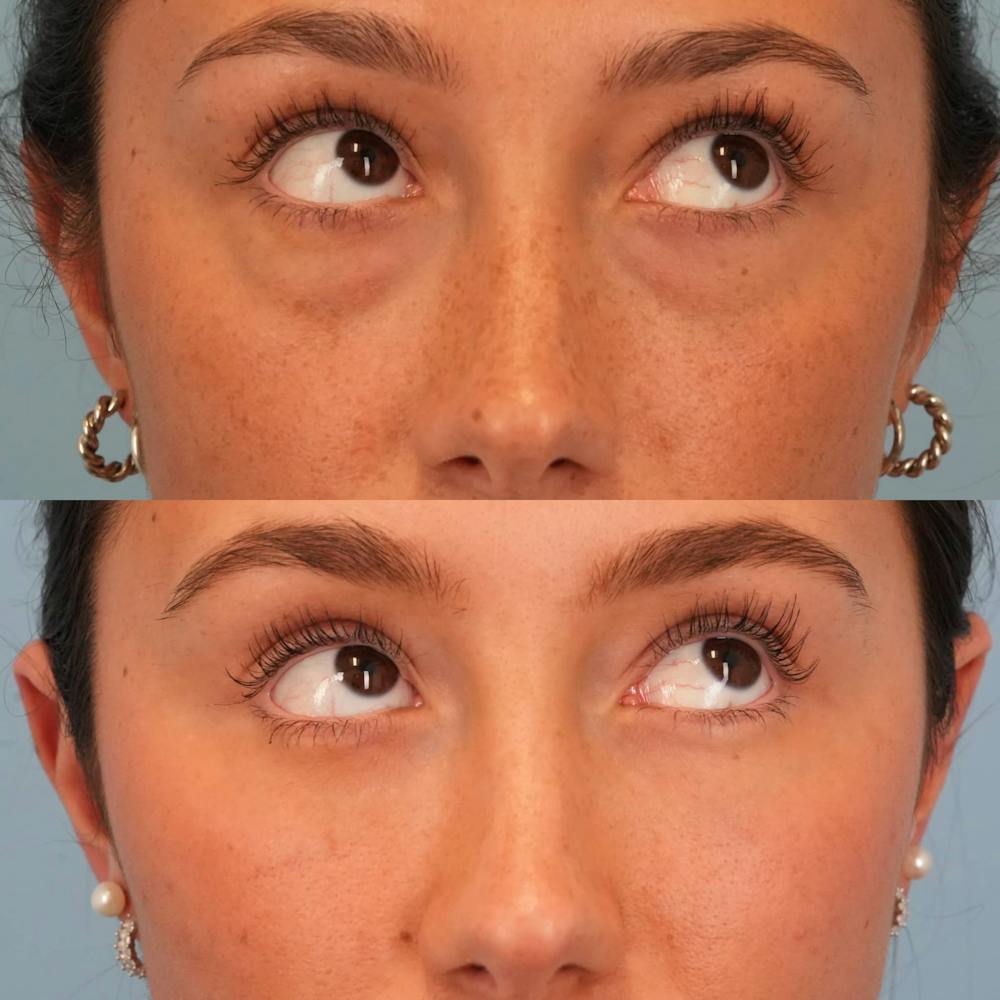 Lower Eyelids Before & After Gallery - Patient 332662 - Image 4