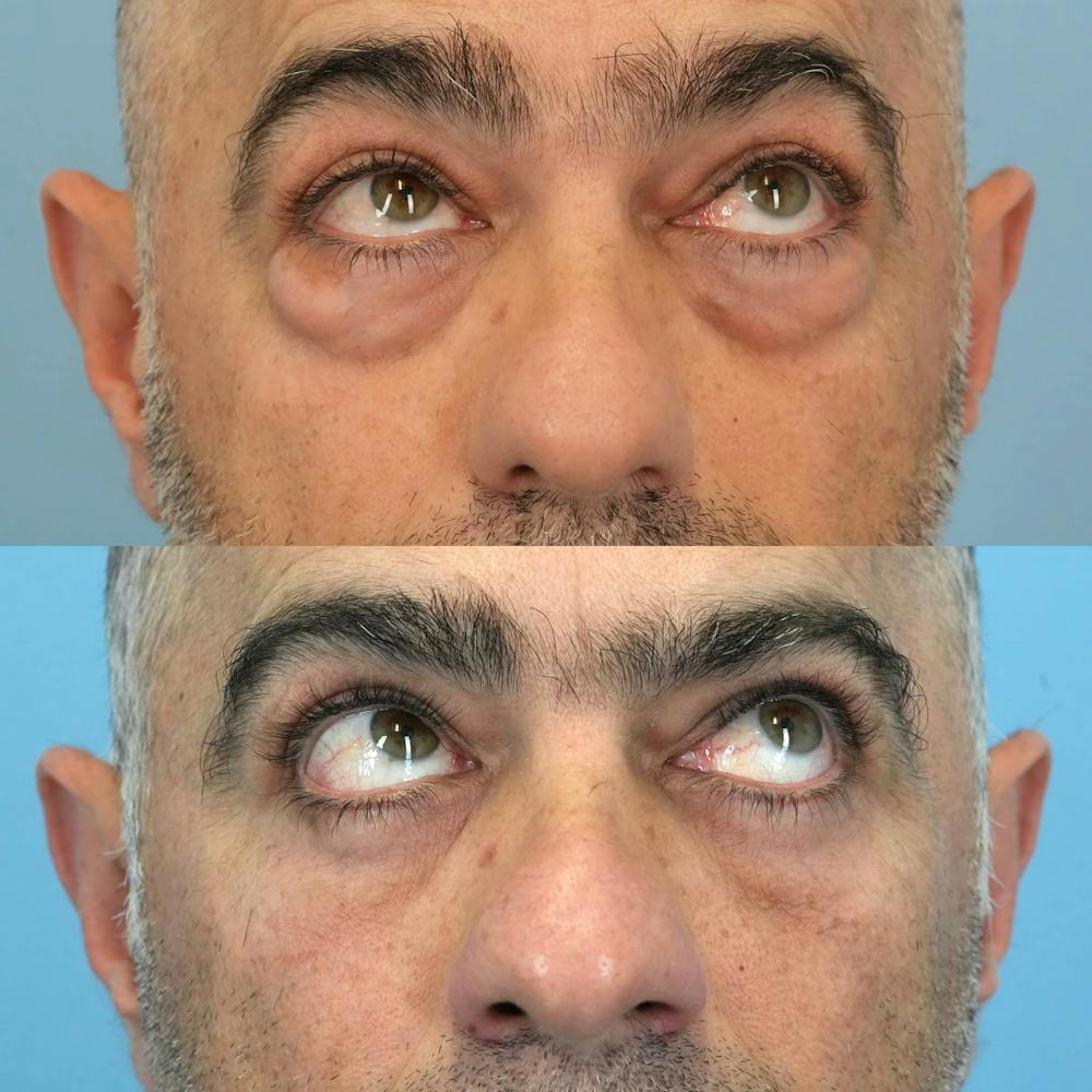 Lower Eyelids Before & After Gallery - Patient 673063 - Image 2