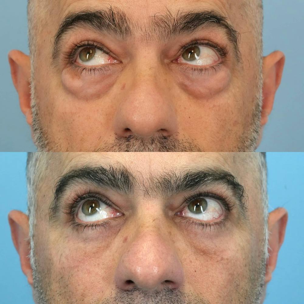Lower Eyelids Before & After Gallery - Patient 673063 - Image 3