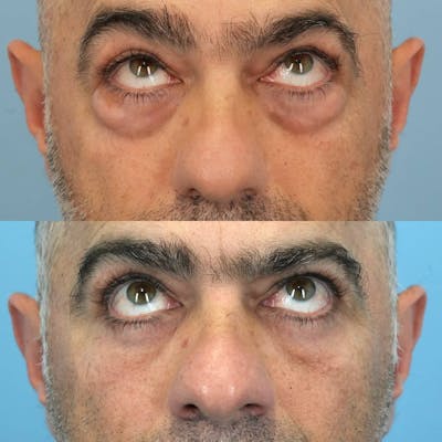 Lower Eyelids Before & After Gallery - Patient 673063 - Image 4