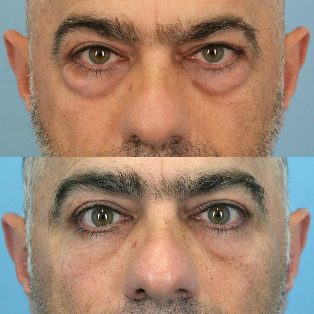 Lower Eyelids Before & After Gallery - Patient 673063 - Image 1