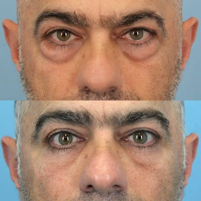 Lower Eyelids Before & After Gallery - Patient 673063 - Image 1
