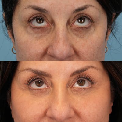Lower Eyelids Before & After Gallery - Patient 440494 - Image 2