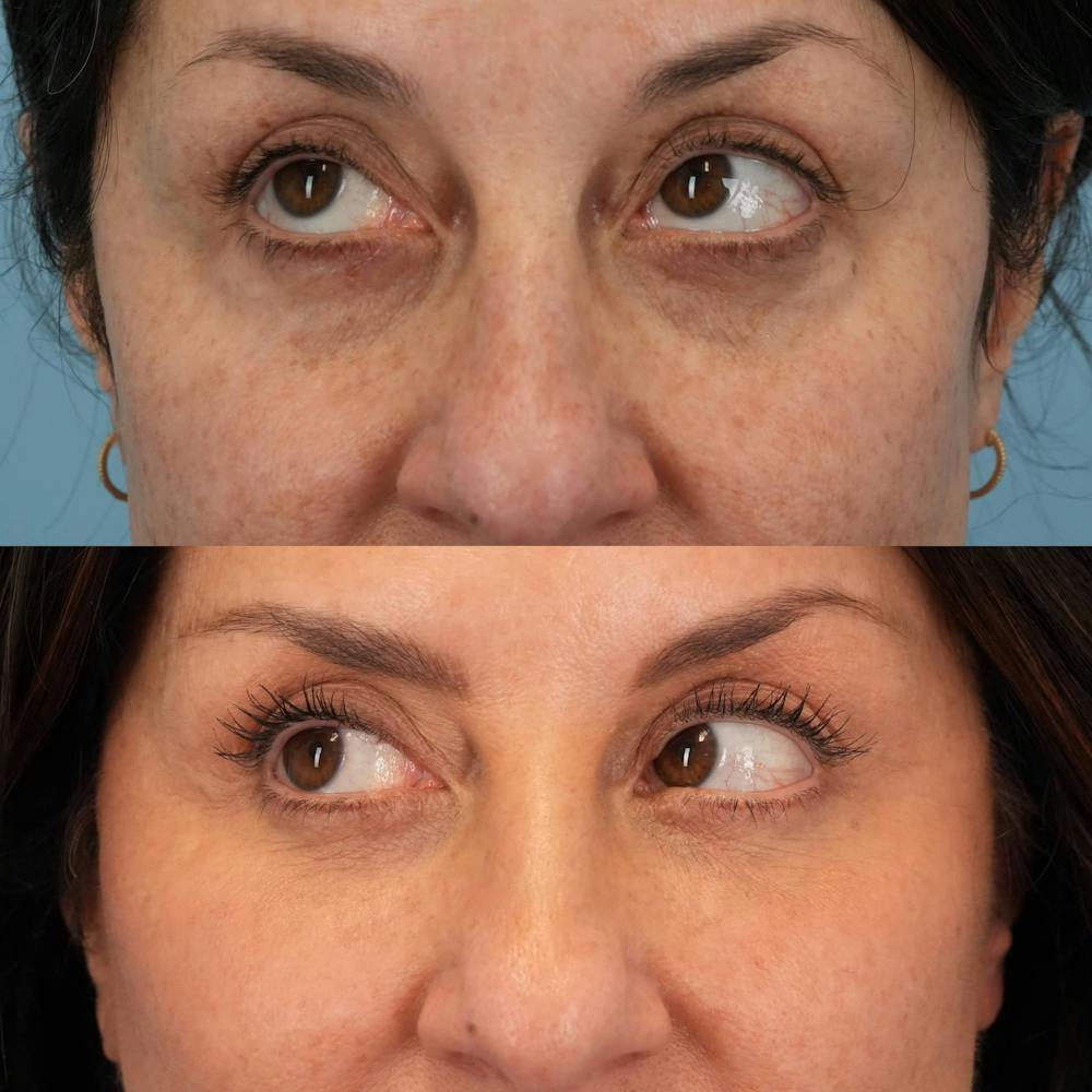 Lower Eyelids Before & After Gallery - Patient 440494 - Image 3