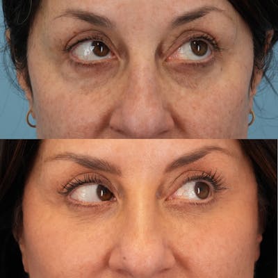 Lower Eyelids Before & After Gallery - Patient 440494 - Image 4