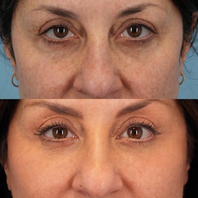 Lower Eyelids Before & After Gallery - Patient 440494 - Image 1