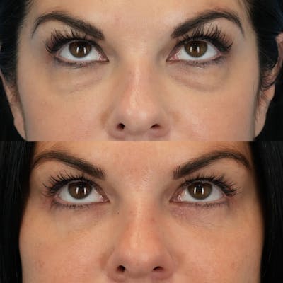 Lower Eyelids Before & After Gallery - Patient 423749 - Image 2