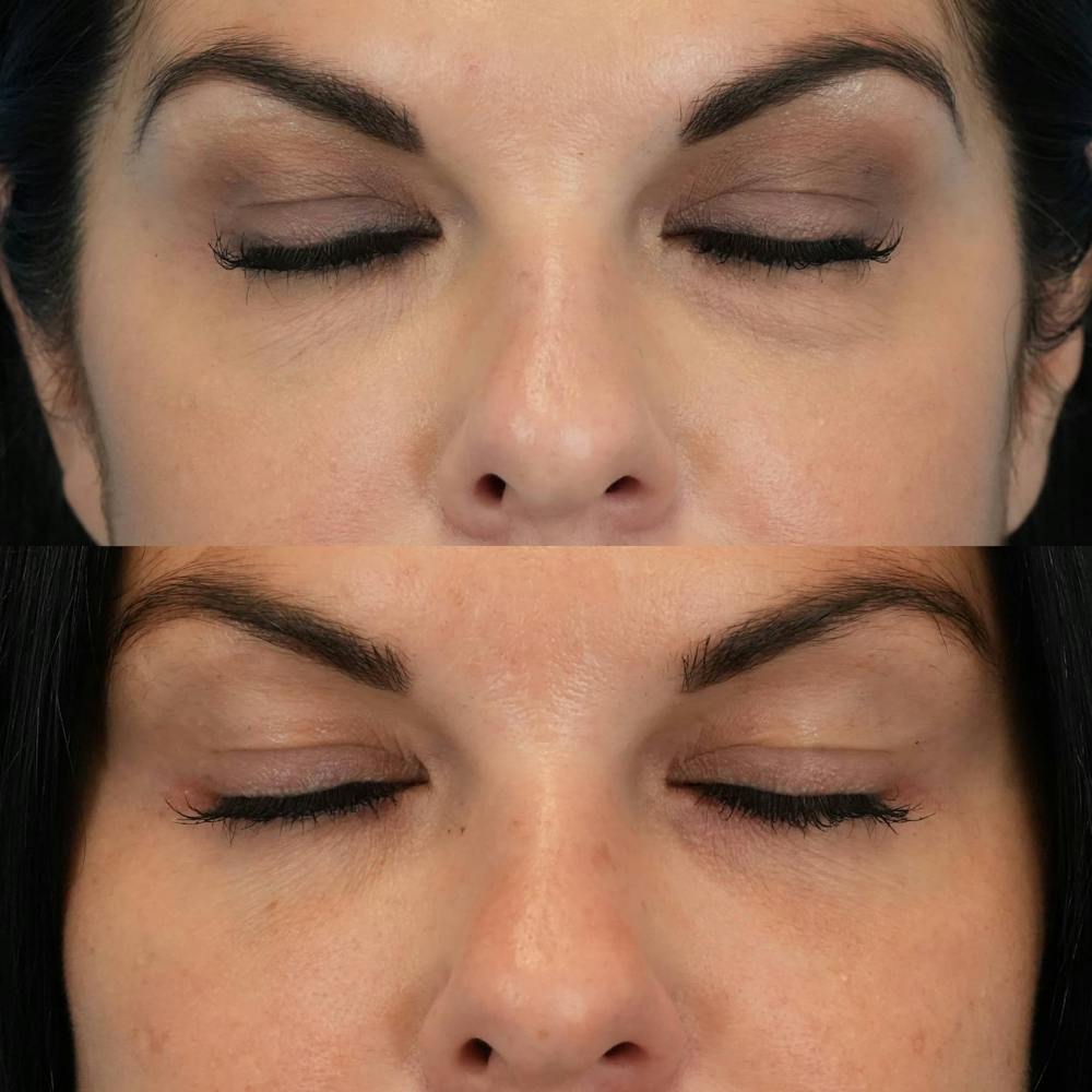 Lower Eyelids Before & After Gallery - Patient 423749 - Image 3