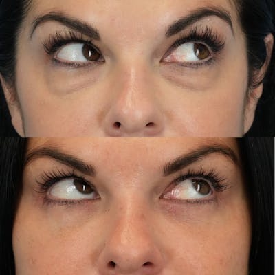 Lower Eyelids Before & After Gallery - Patient 423749 - Image 4