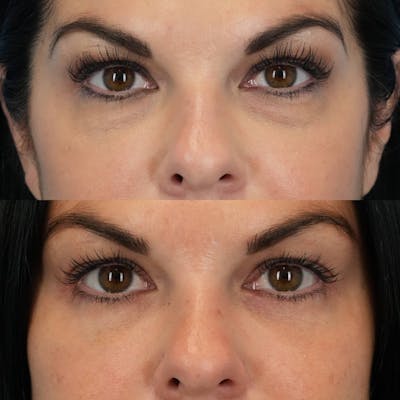 Lower Eyelids Before & After Gallery - Patient 423749 - Image 1