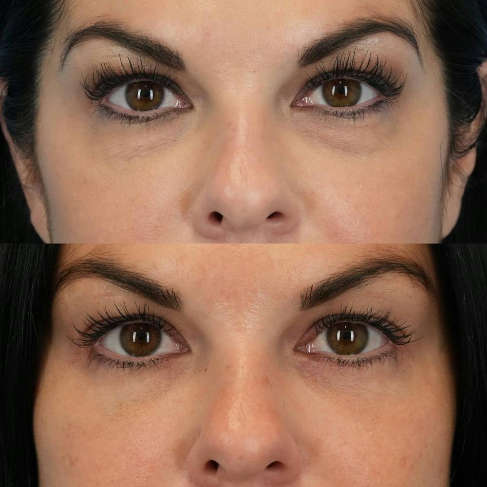 Lower Eyelids Before & After Gallery - Patient 423749 - Image 1