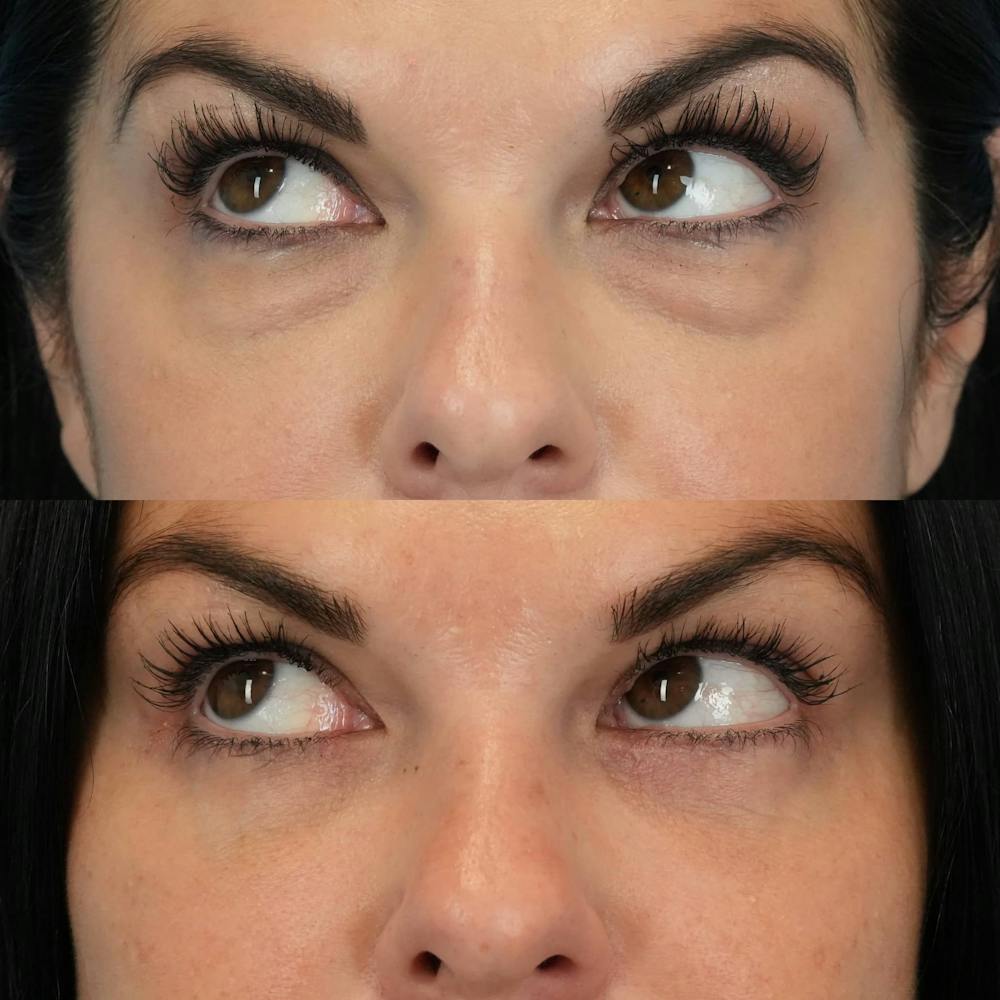 Lower Eyelids Before & After Gallery - Patient 423749 - Image 5