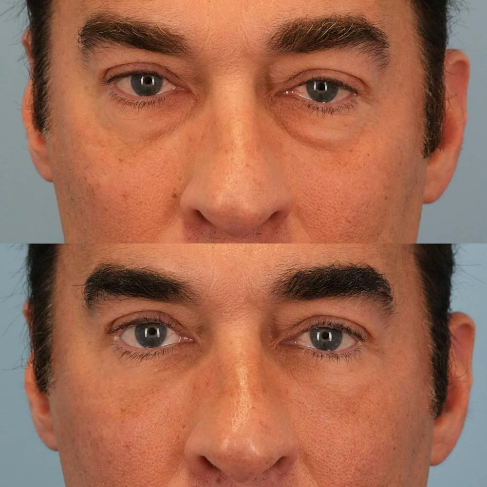 Lower Eyelids Before & After Gallery - Patient 163792 - Image 1