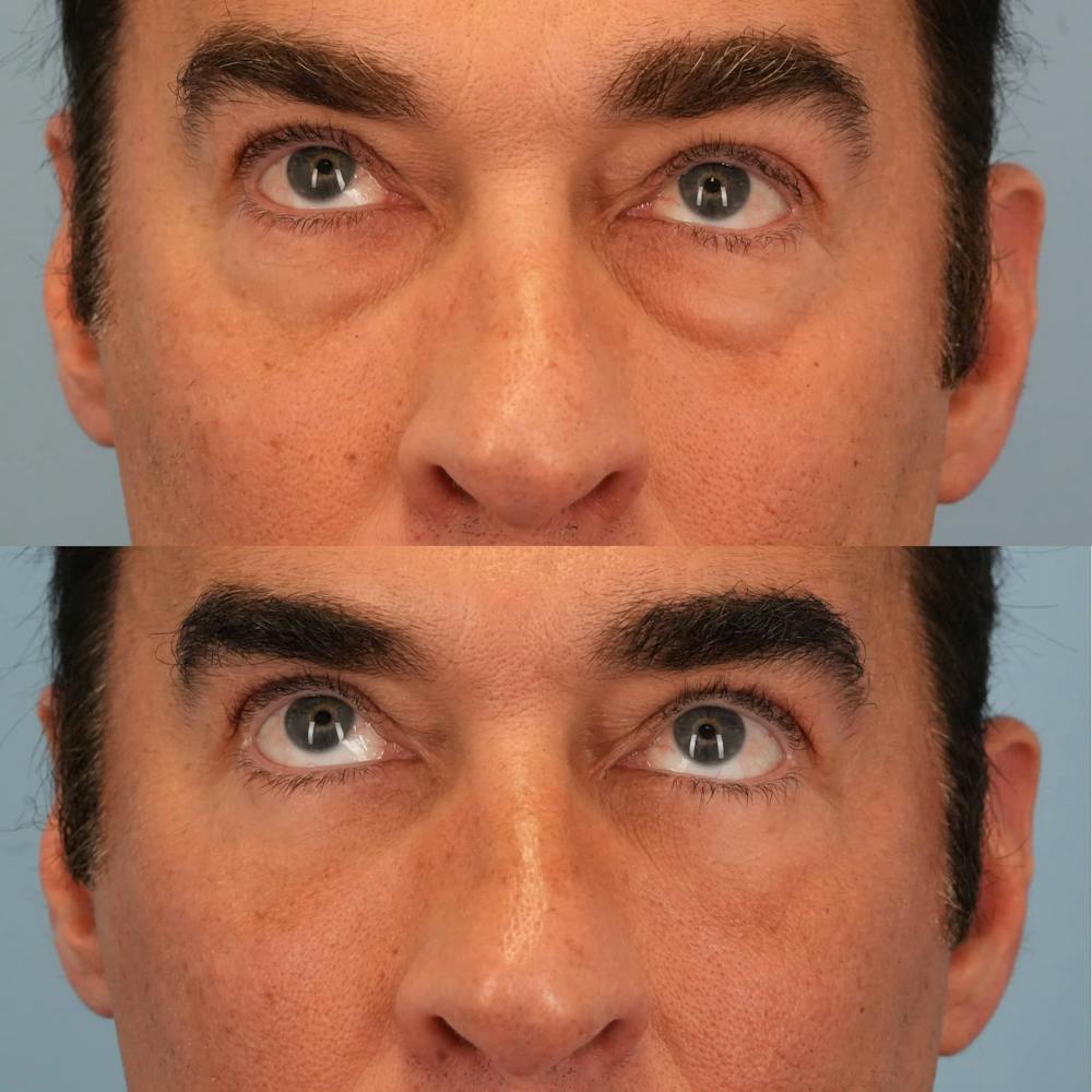 Lower Eyelids Before & After Gallery - Patient 163792 - Image 3