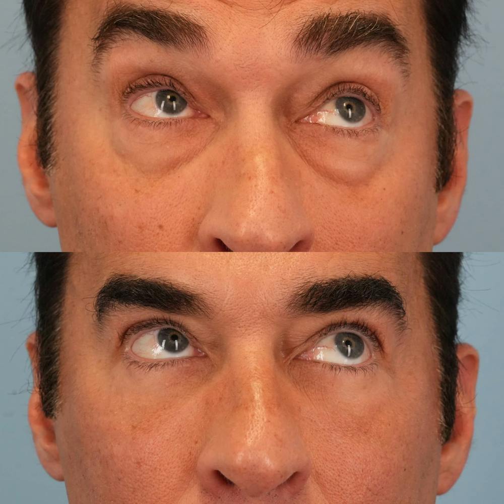 Lower Eyelids Before & After Gallery - Patient 163792 - Image 4