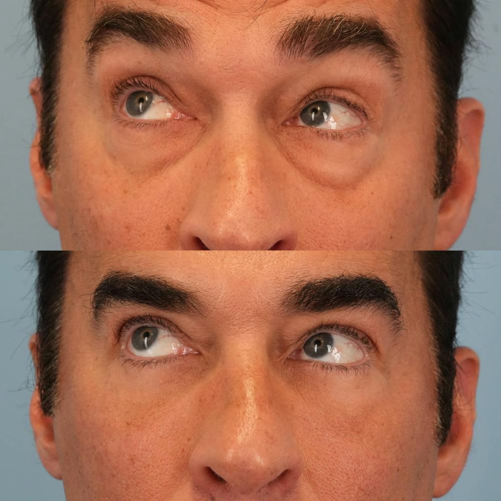 Lower Eyelids Before & After Gallery - Patient 163792 - Image 5