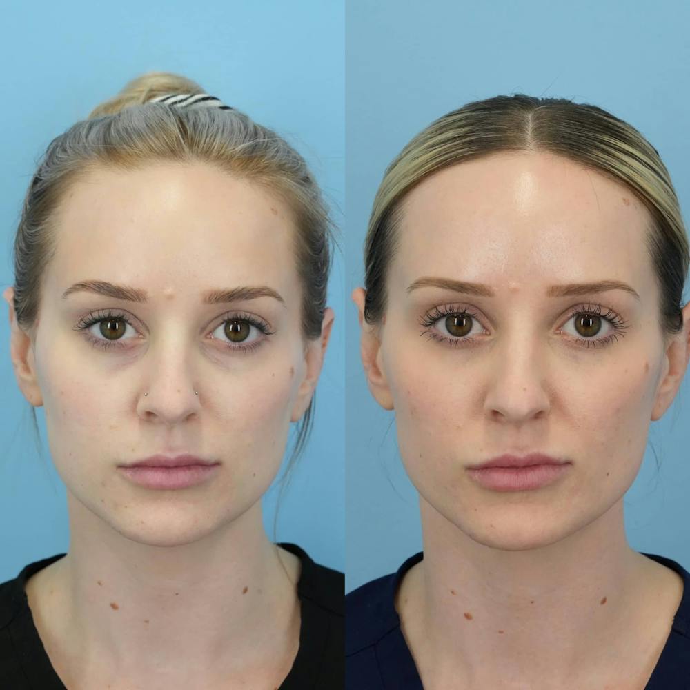 Dermal Fillers Before & After Gallery - Patient 418913 - Image 5