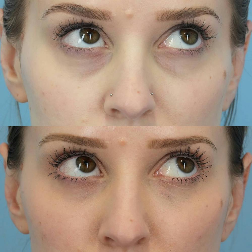 Dermal Fillers Before & After Gallery - Patient 418913 - Image 2