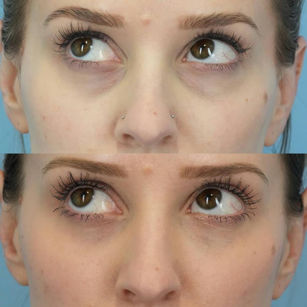 Dermal Fillers Before & After Gallery - Patient 418913 - Image 3