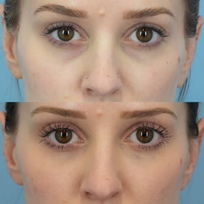 Dermal Fillers Before & After Gallery - Patient 418913 - Image 1