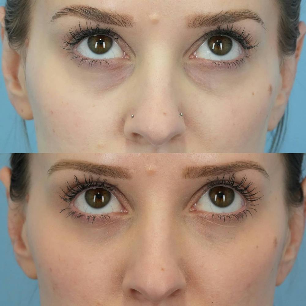 Dermal Fillers Before & After Gallery - Patient 418913 - Image 4