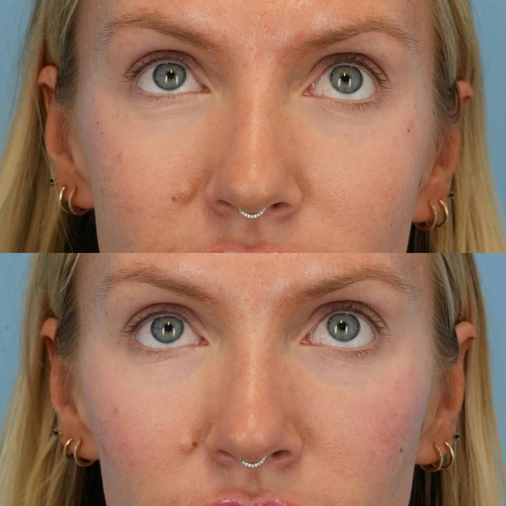 Dermal Fillers Before & After Gallery - Patient 155729 - Image 2
