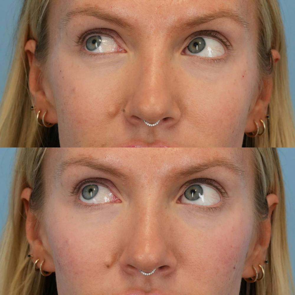 Dermal Fillers Before & After Gallery - Patient 155729 - Image 3