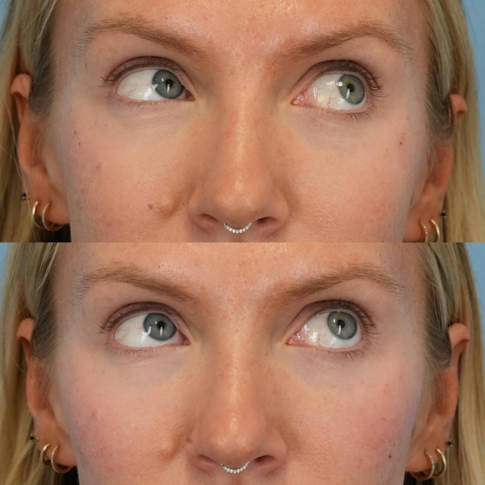 Dermal Fillers Before & After Gallery - Patient 155729 - Image 4