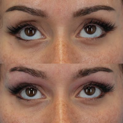Dermal Fillers Before & After Gallery - Patient 239234 - Image 2