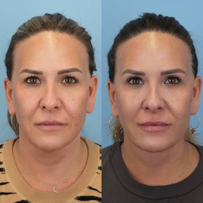 Upper Eyelids Before & After Gallery - Patient 864979 - Image 1