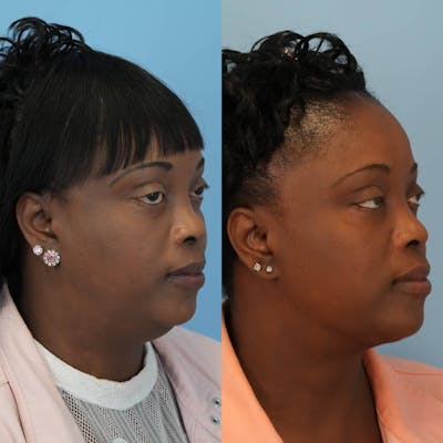 Neck Lift Before & After Gallery - Patient 323083 - Image 2