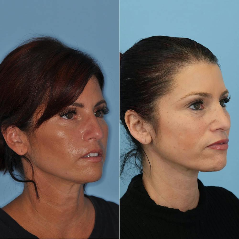 Neck Lift Before & After Gallery - Patient 211072 - Image 2