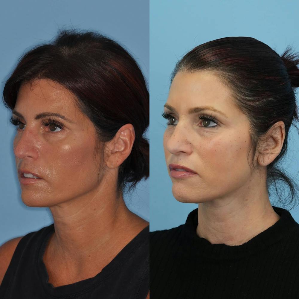 Neck Lift Before & After Gallery - Patient 211072 - Image 5