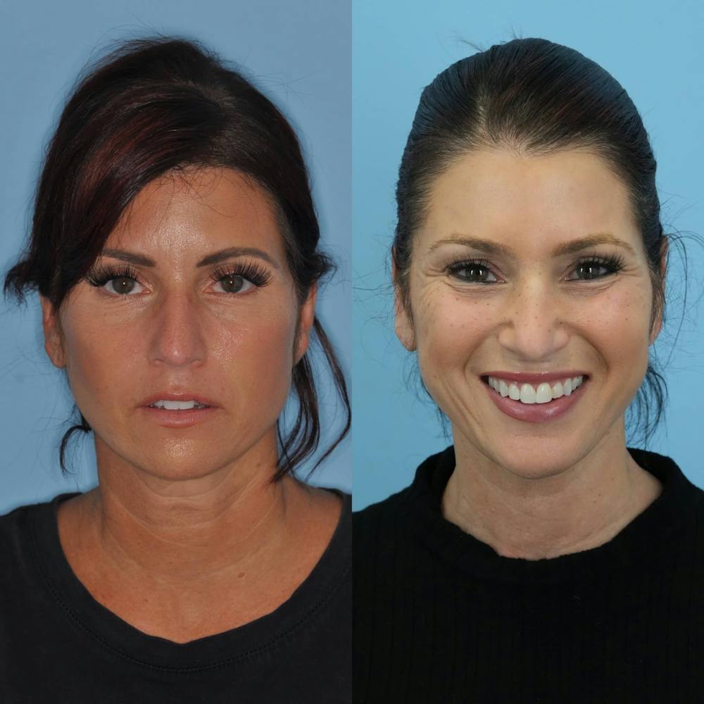 Neck Lift Before & After Gallery - Patient 211072 - Image 3