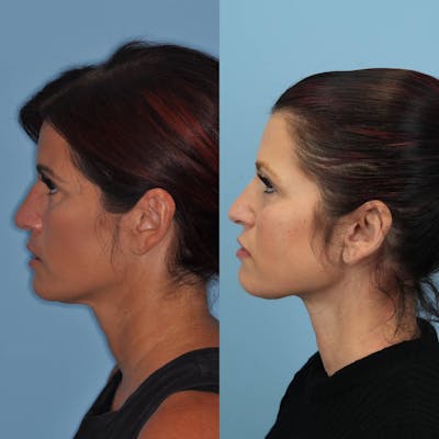 Neck Lift Before & After Gallery - Patient 211072 - Image 4